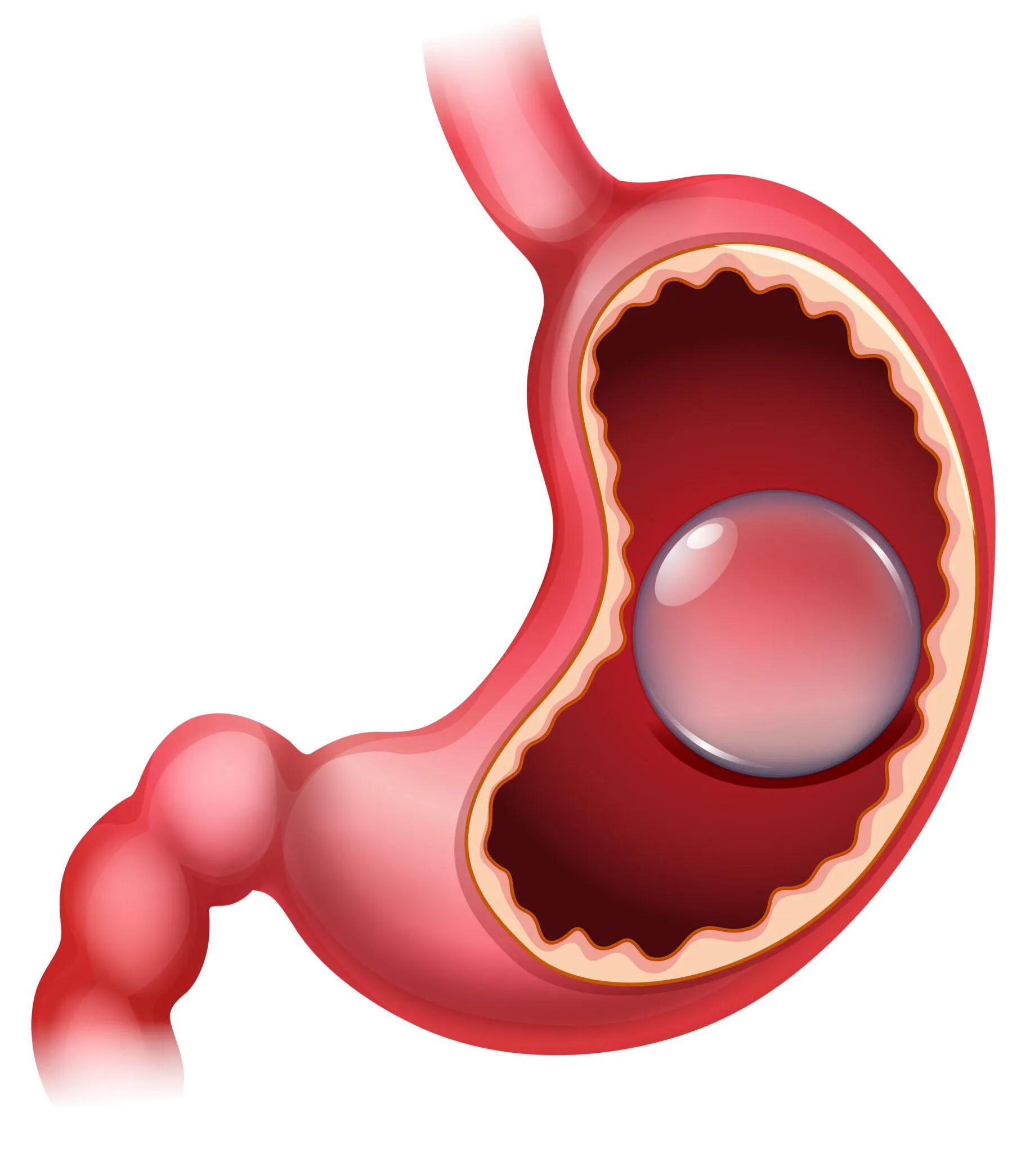 Gastric Balloon