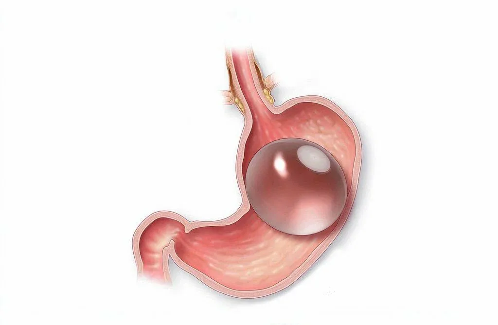 Best Gastric Balloon in Islamabad