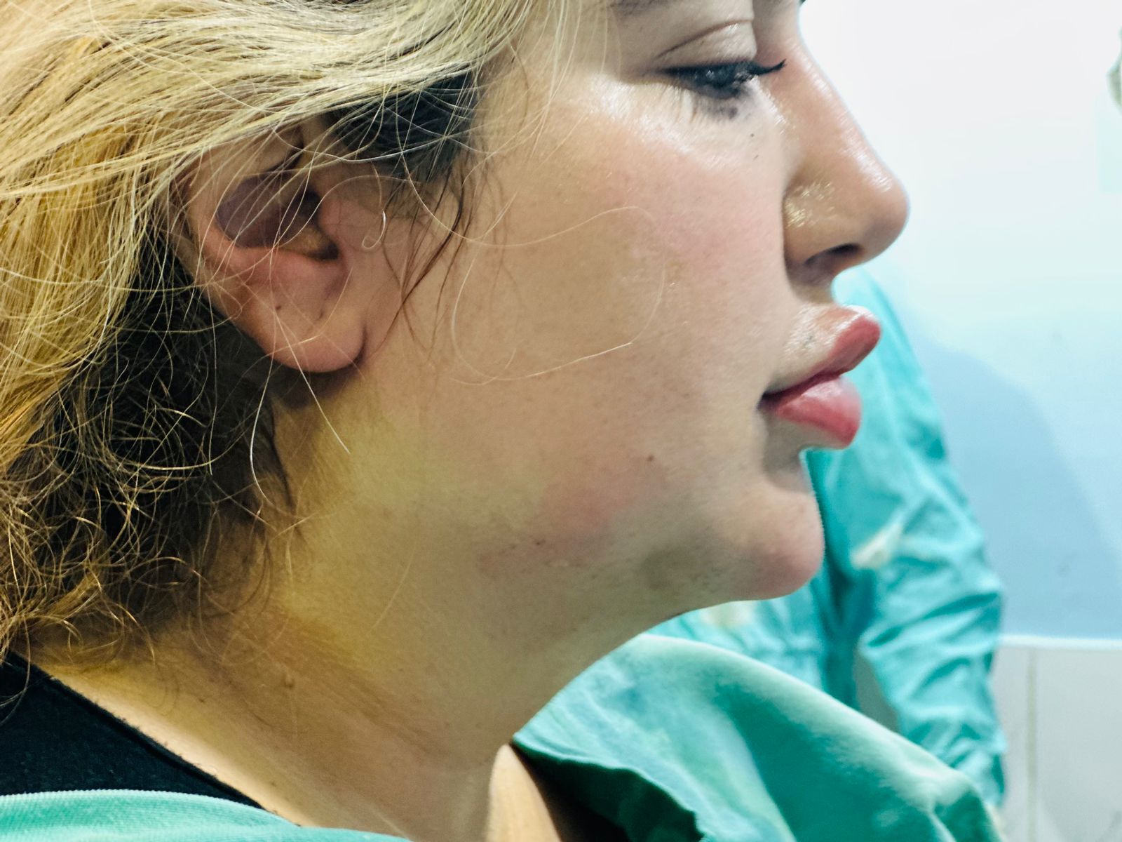Double Chin Reduction after