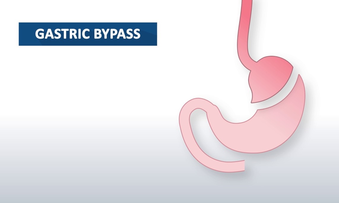 Gastric Bypass Surgery in Rawalpindi,Islamabad