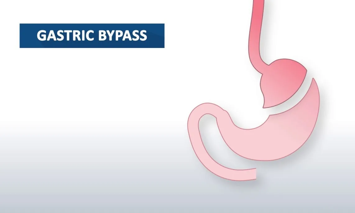 Gastric Bypass Surgery in Rawalpindi,Islamabad