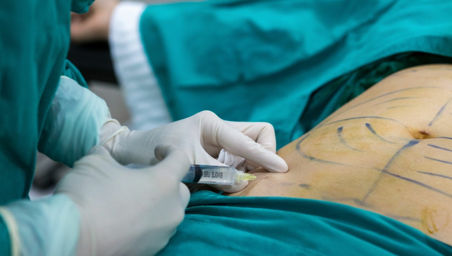 Liposuction Surgery in Islamabad