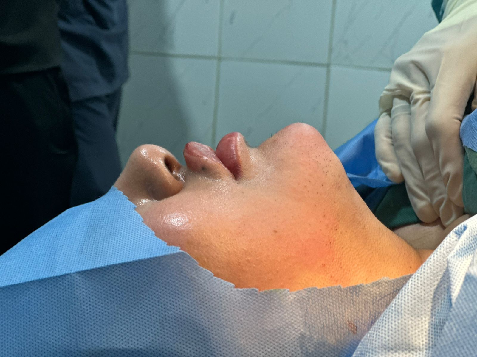Double Chin Treatments