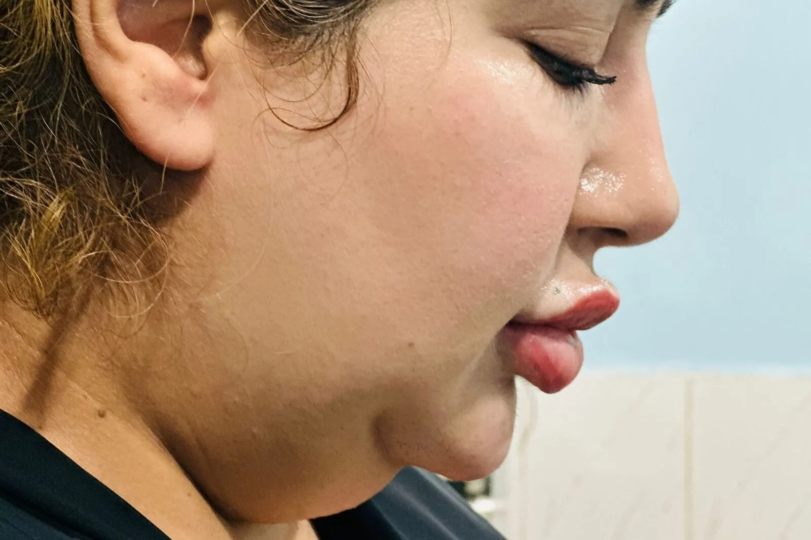 Double chin