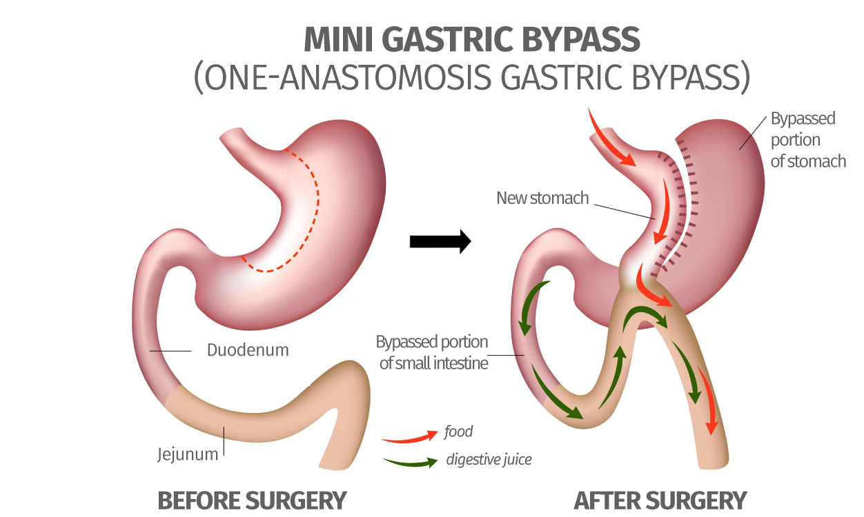 Mini Gastric Bypass Surgery in Islamabad