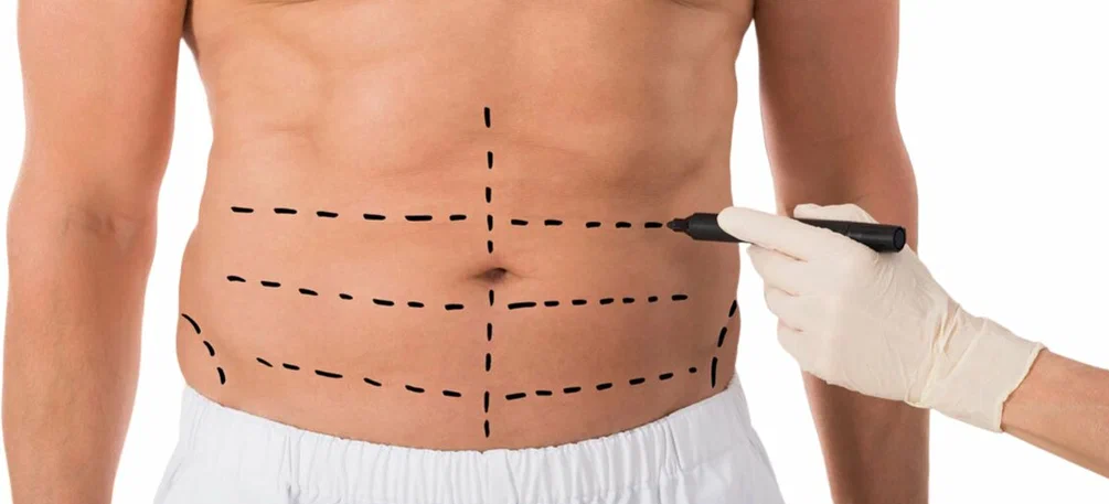 What Is the Most Common Complication of Liposuction?