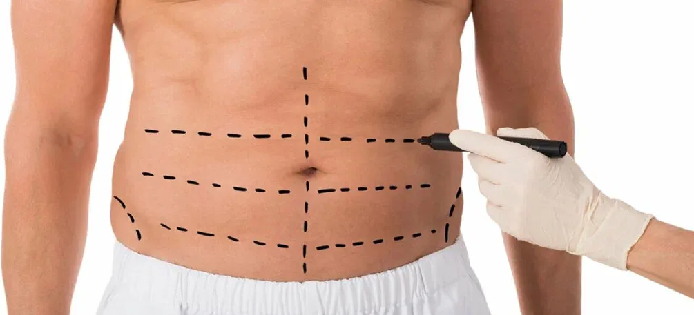 What Is the Most Common Complication of Liposuction
