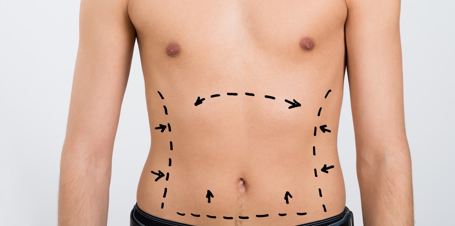 Can Teenagers Go for Liposuction Surgery in Pakistan