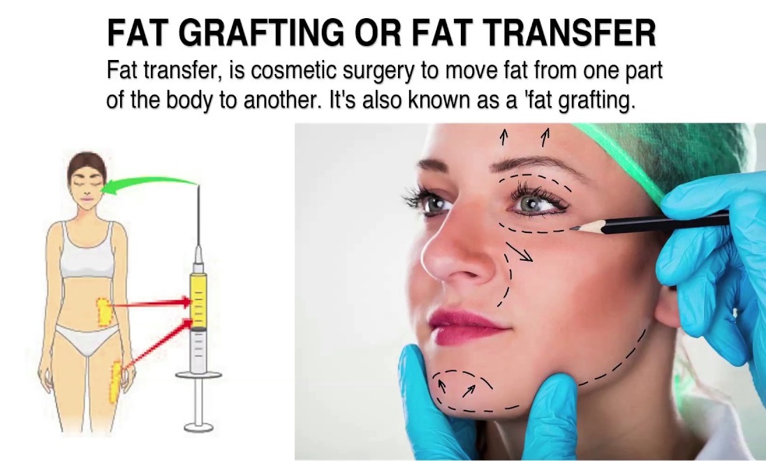 Can fat transfer cause blood clots