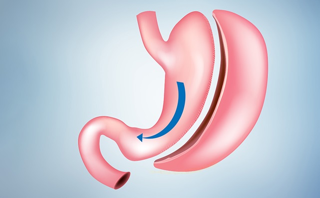 Can you sleep after gastric sleeve surgery