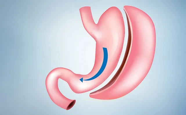 Can you sleep after gastric sleeve surgery