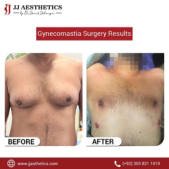 Best Doctors for Gynecomastia Male Breast Reduction in Islamabad
