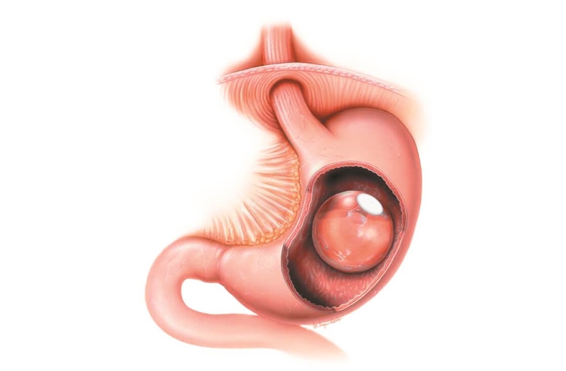 Different types of gastric balloons