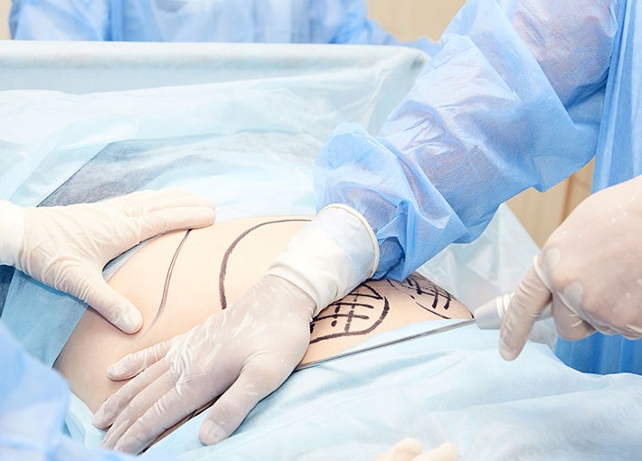 Is Liposuction a Safe Fat Removal Treatment in Islamabad?