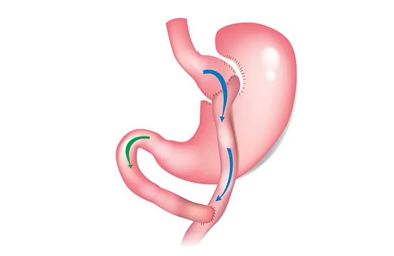 Is gastric bypass a serious surgery?