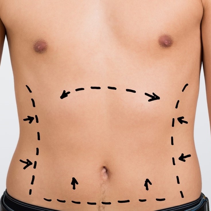 Liposuction