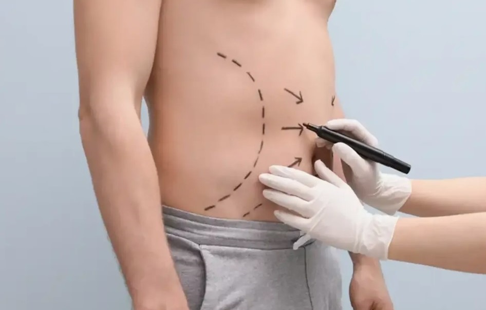 Price of Abdominoplasty in Pakistan 2025