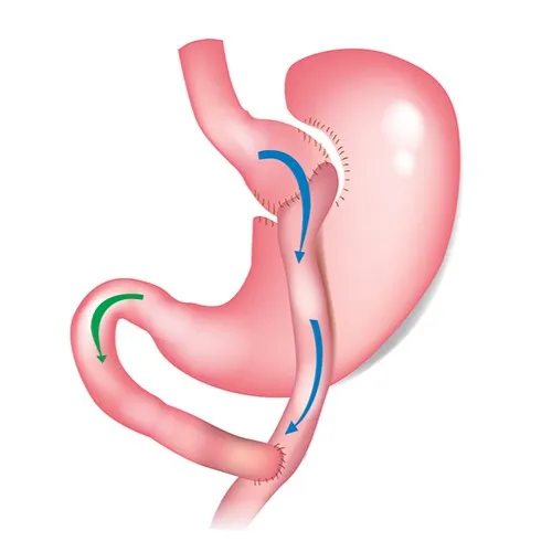 Gastric Bypass