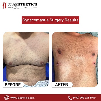 gynecomastia surgery cost in islamabad