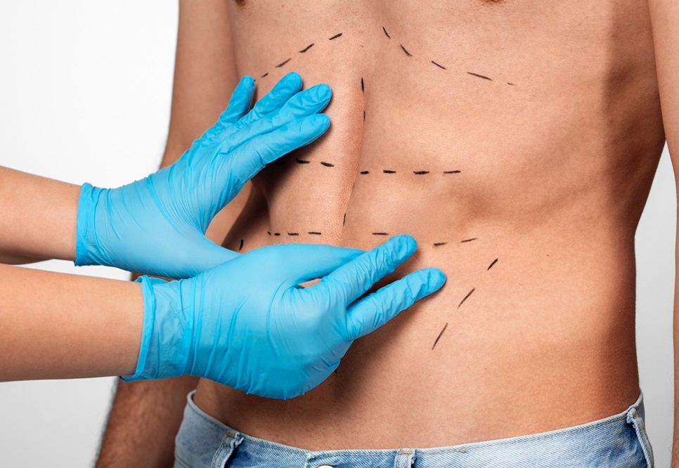 5 Ways to Reduce Swelling After Liposuction