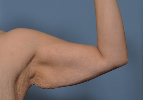 Arm lift liposuction in Islamabad