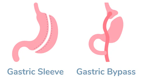 Gastric bypass vs gastric sleeve: how are they different in Islamabad?
