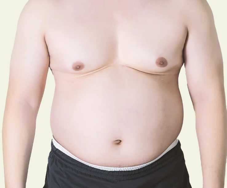 How you can get rid of gynecomastia without surgery in Islamabad