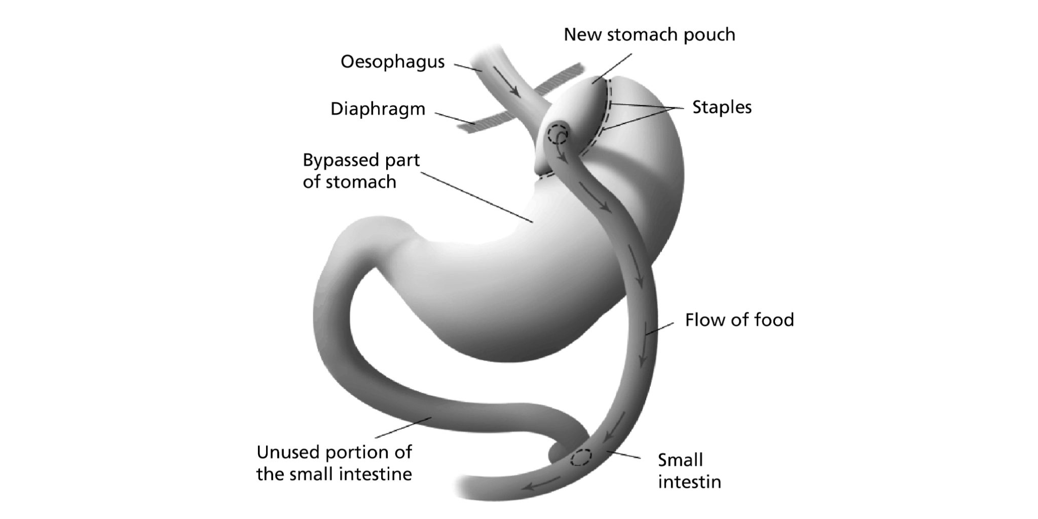 roux en y gastric bypass in Islamabad