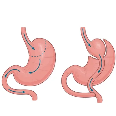 What happens to stomach acid during gastric bypass