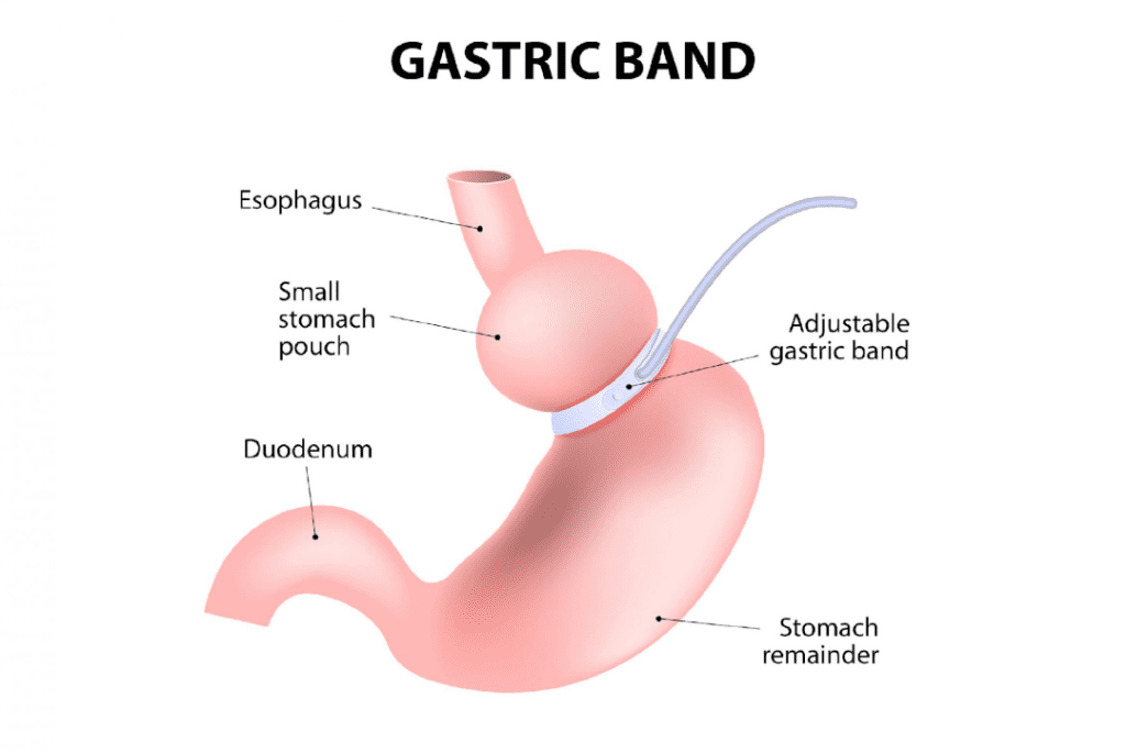 gastric banding in Islamabad