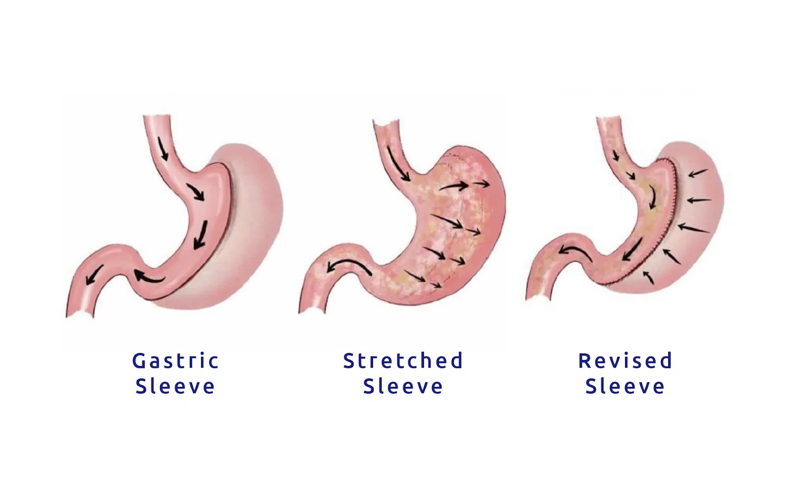 How do I know if I stretched my gastric sleeve