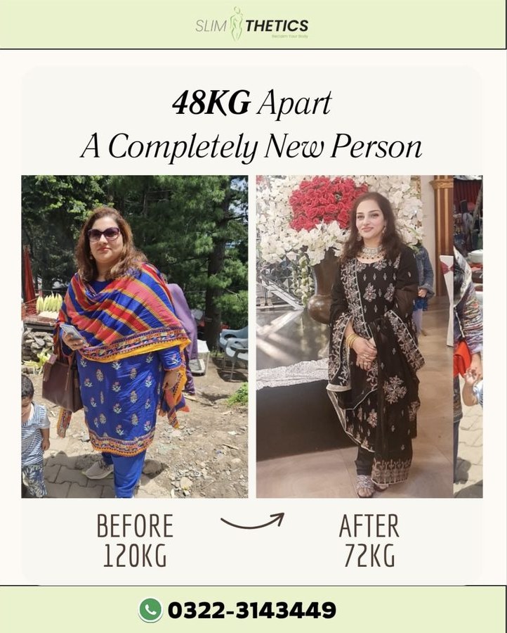 Before and after weight loss transformation at Slimthetics 1