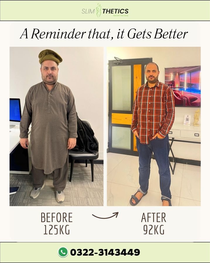 Before and after weight loss transformation at Slimthetics 3
