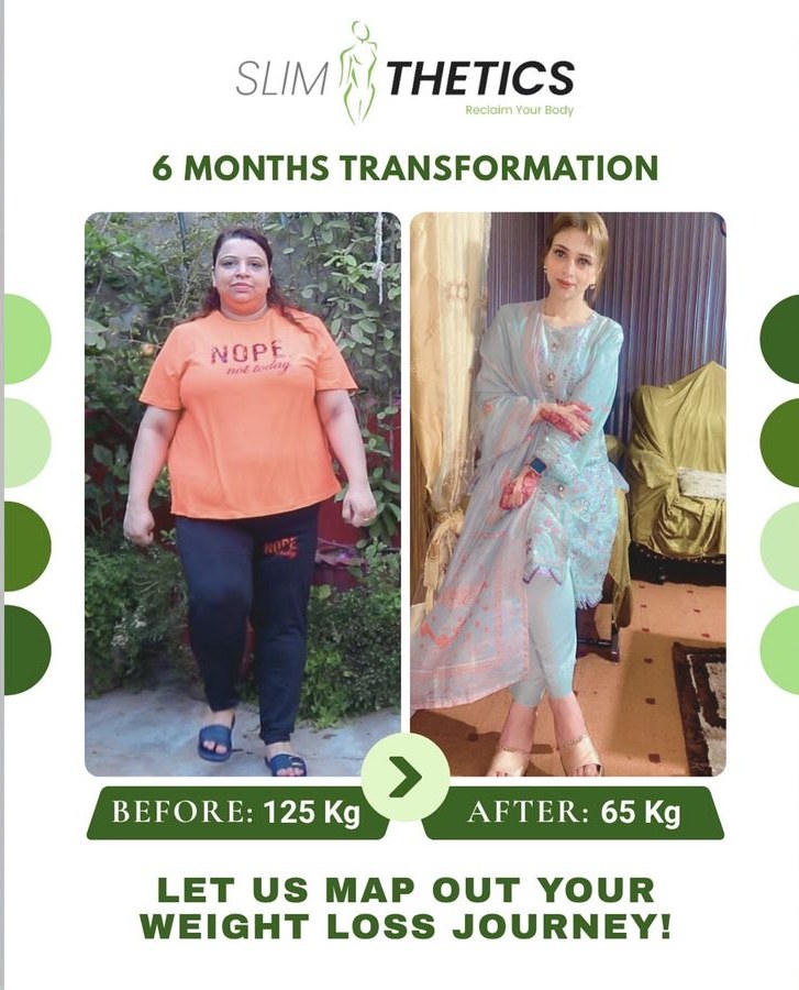 Before and after weight loss transformation at Slimthetics 5